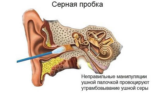 Пробка в ухе симптомы в домашних условиях 220