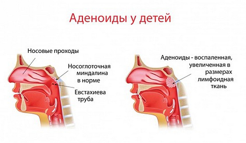 Грибок ногтей схема лечения отзывы Грибок ногтей схема лечения отзывы